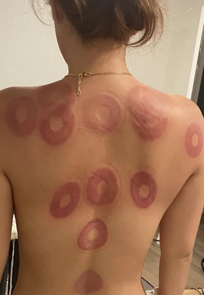 Intelligent Vacuum Cupping Massage